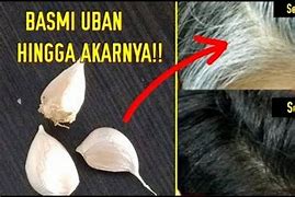 Rambut Tidak Tumbuh Sebagian